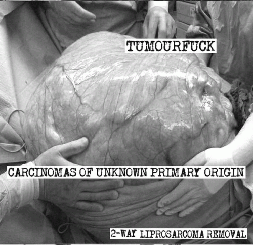 Carcinomas Of Unknown Primary Origin : 2-way Liprosarcoma Removal